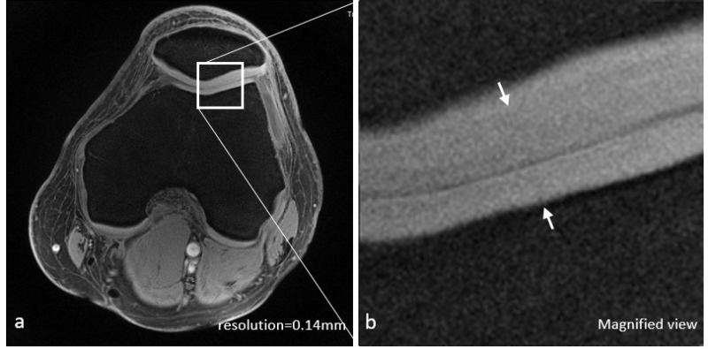 UTE image of a health knee